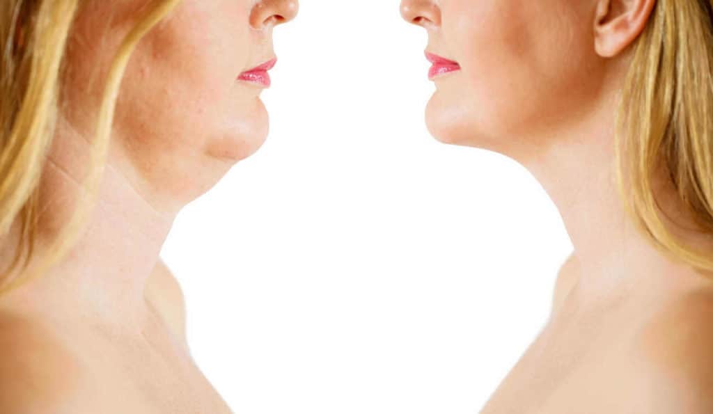 Double Chin treatment Greater London (Tower Hamlets) before and after results