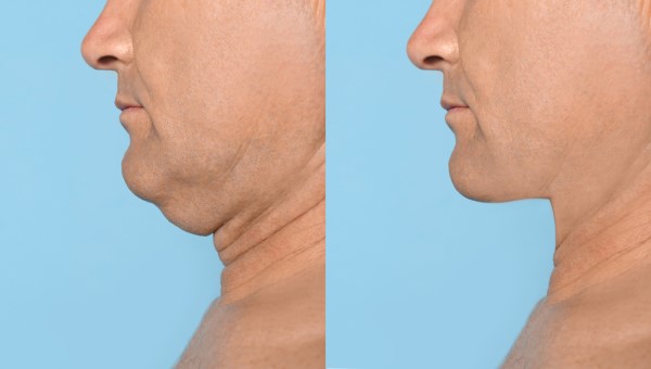 Which Non-Surgical Treatments Work Best for Jowls and Loose Skin Greater London (Tower Hamlets)?