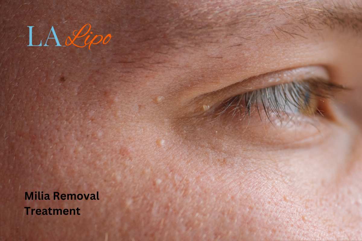 Cryopen Milia Removal: Is It the Easiest and Safest Option Greater London (Tower Hamlets)?
