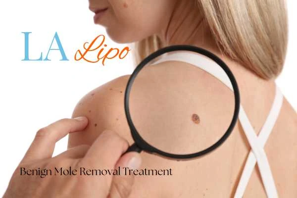 Why getting moles removed Greater London (Tower Hamlets) can boost your confidence!