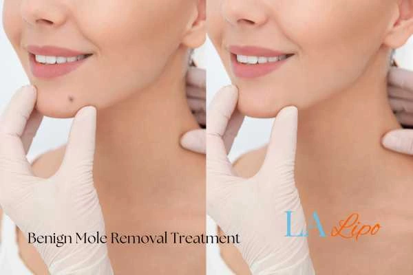 woman's before and after mole removal Greater London (Tower Hamlets) results