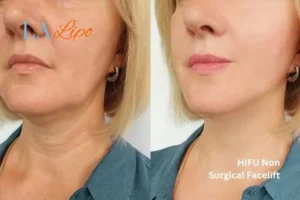 hi-fu for wrinkles Greater London (Tower Hamlets) before and after results