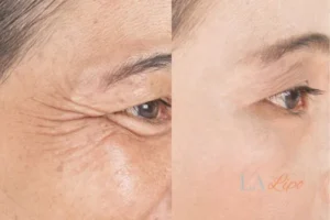 Before and after results of woman - HI-fu wrinkles reduction treatment Greater London (Tower Hamlets)