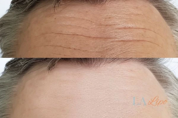 results of HIFU Greater London (Tower Hamlets) on mans forehead to help reduce lines and wrinkles