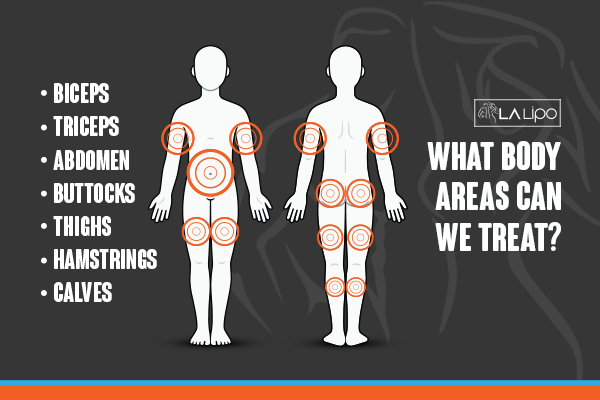 Graphic to show areas you can have LA-EMS Body Sculpting Greater London (Tower Hamlets) treatment.