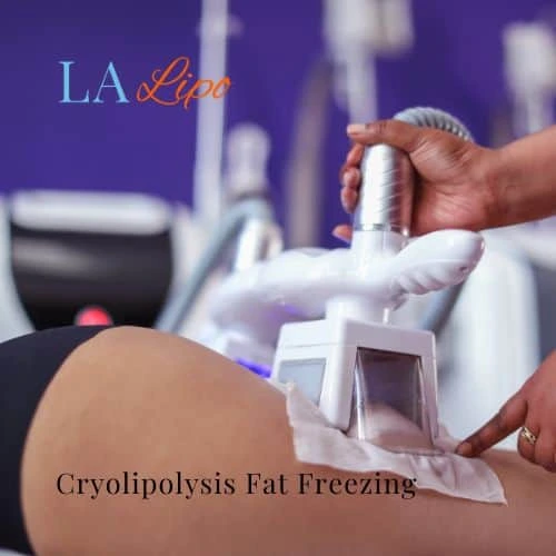 fat freezing - Cryolipolysis Greater London (Tower Hamlets)