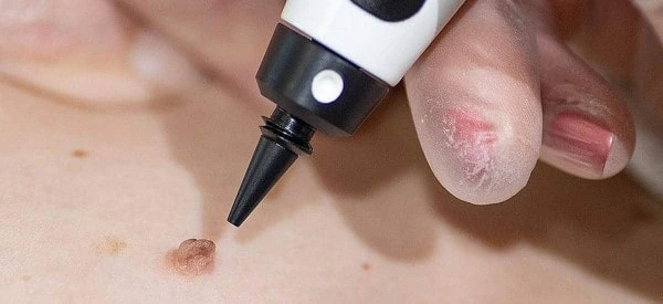 skin tag removal using cryopen Greater London (Tower Hamlets)