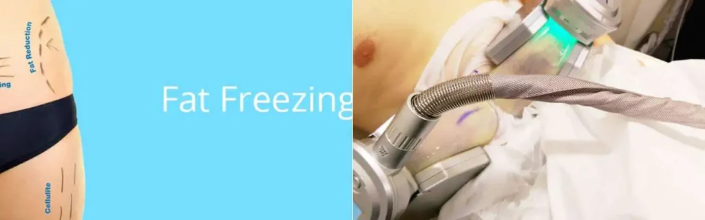 multi areas of a persons body having coolsculpting Greater London (Tower Hamlets) treatment