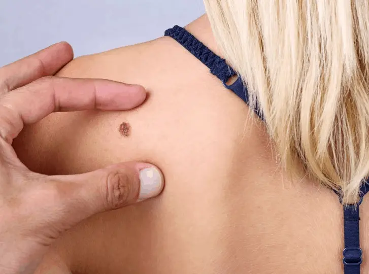 woman having mole removal Greater London (Tower Hamlets) consultation before treatment.