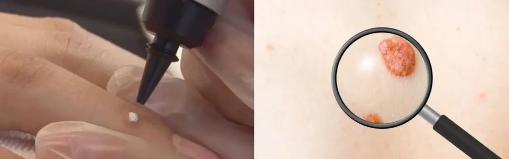 Cryopen for mole removal Greater London (Tower Hamlets) - speak to our team today!
