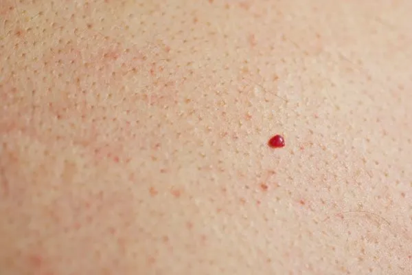 close up of a cherry angioma Greater London (Tower Hamlets)