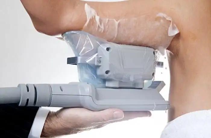 Picture of fat freezing Greater London (Tower Hamlets) on the upper arms.