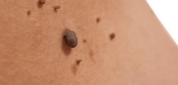 image of a skin tag Greater London (Tower Hamlets)