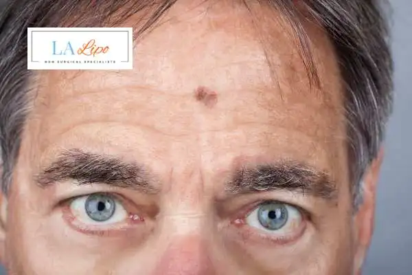 Solar Lentigo Removal Greater London (Tower Hamlets) image of man with mark on his forehead