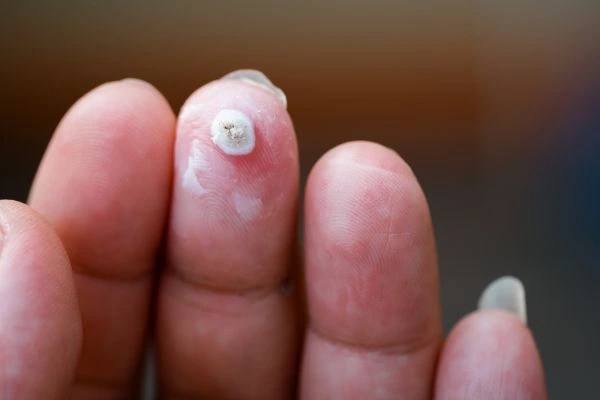 wart on person finger - cryotherapy to treat from LA LIPO Greater London (Tower Hamlets)