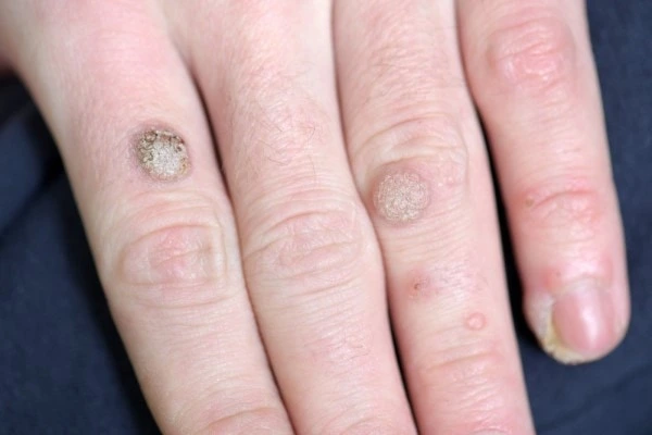 photo of warts on person hand - see wart removal Greater London (Tower Hamlets) from LA LIPO