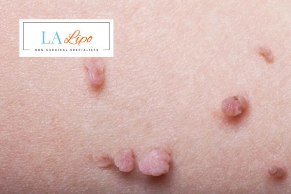 Does cryopen skin tag removal Greater London (Tower Hamlets) hurt? Find out now call our team today!