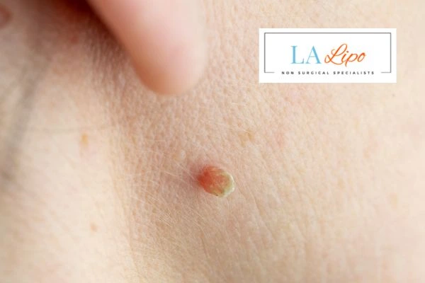 Book skin tag removal Greater London (Tower Hamlets) today speak to our team now!