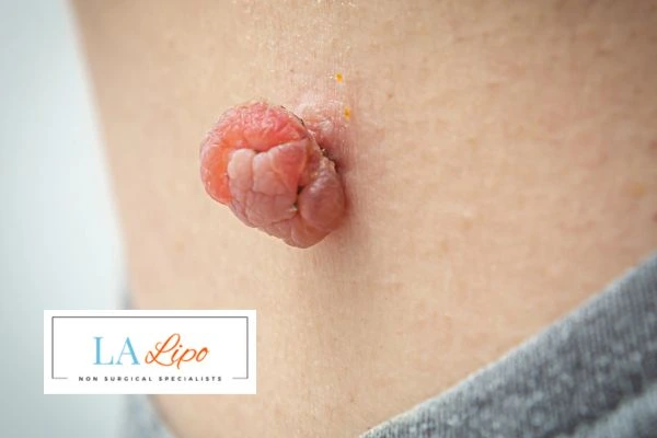 Interested in skin tag removal Greater London (Tower Hamlets)? Concerned about the pain? Find out more today!