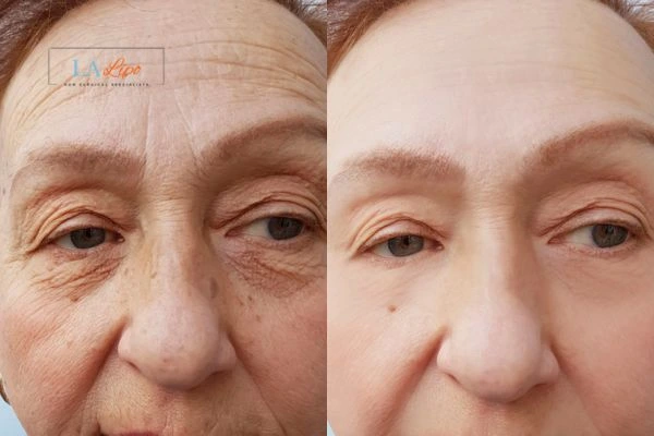 The powerful benefits of Morpheus8 Treatment Greater London (Tower Hamlets) - Call Our team today!