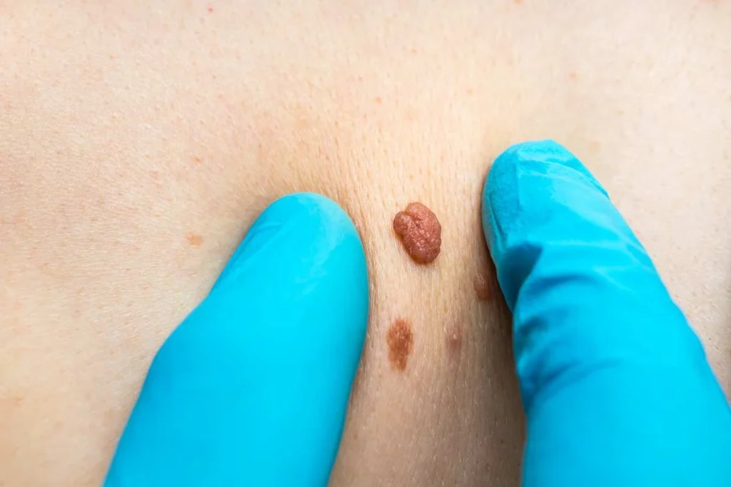 LA LIPO Cryopen Lesion Removal Prices Greater London (Tower Hamlets)