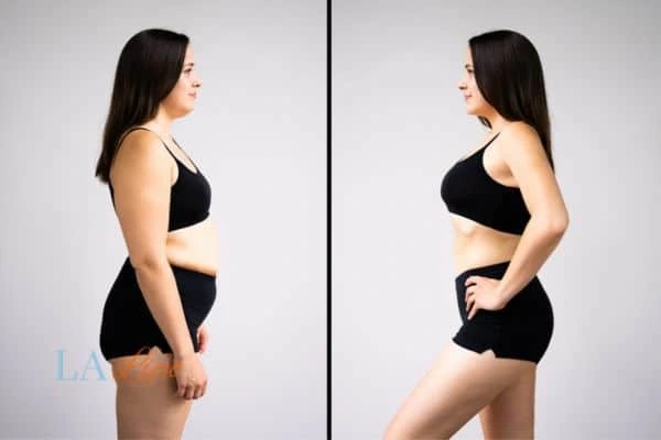 Picture of womans before and after using LA-EMS body sculpting to improve her core strength Greater London (Tower Hamlets)