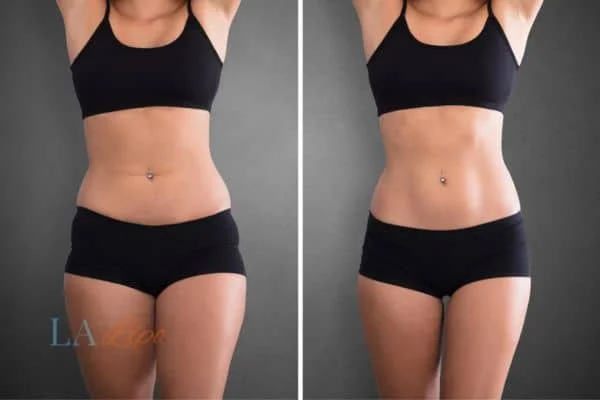 before and after results of non-surgical treatment to help a woman's body image and mental health Greater London (Tower Hamlets)