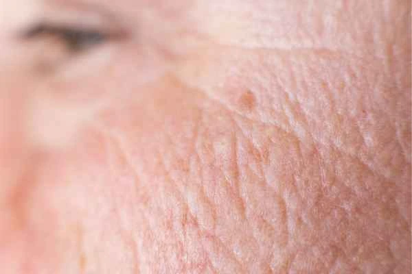 close up picture of a woman's face showing an age spot Greater London (Tower Hamlets)