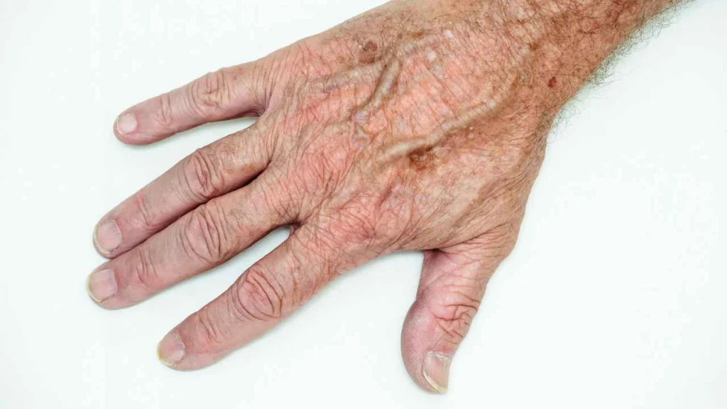 Male hand showing age spot Greater London (Tower Hamlets)