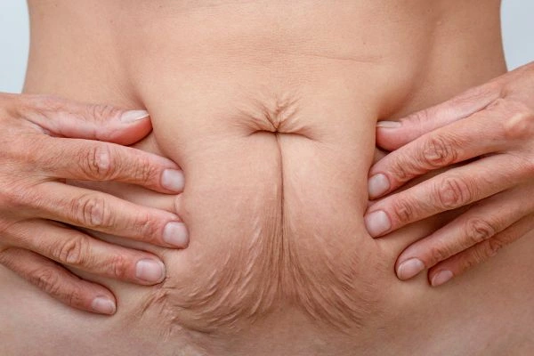 Image of a woman's stomach with loose skin - example of skin tightening Greater London (Tower Hamlets) options