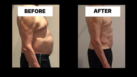 What Symptoms Can Diastasis Recti Cause in Men? Weak Core, Back Pain and Poor Posture Greater London (Tower Hamlets)